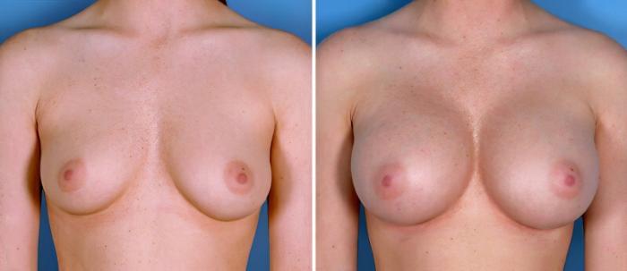 Before & After Breast Augmentation Case 24918 View #1 View in Alpharetta, GA
