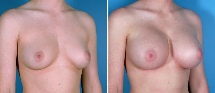 Before & After Breast Augmentation Case 24918 View #2 View in Alpharetta, GA