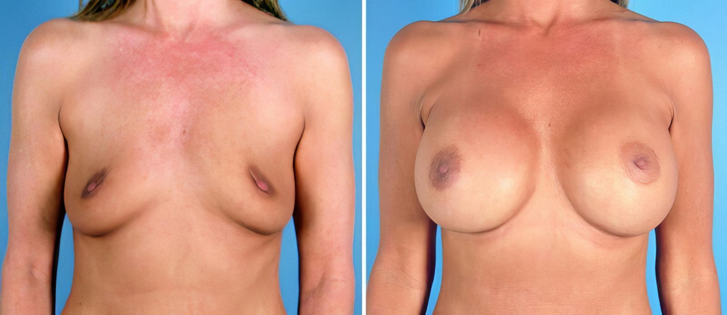 Before & After Breast Augmentation Case 24921 View #1 View in Alpharetta, GA