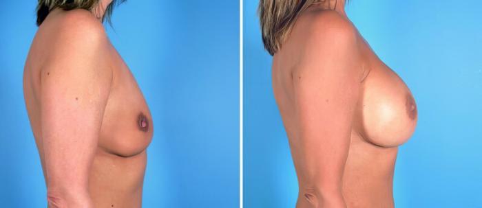 Before & After Breast Augmentation Case 24921 View #2 View in Alpharetta, GA