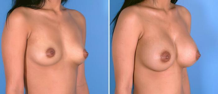 Before & After Breast Augmentation Case 24924 View #2 View in Alpharetta, GA
