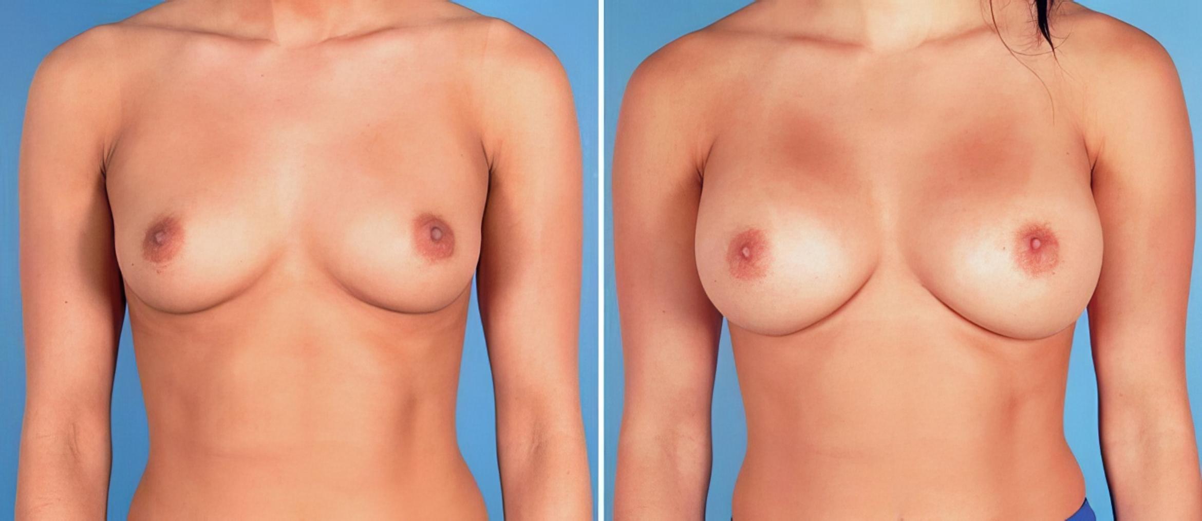 Before & After Breast Augmentation Case 24927 View #1 View in Alpharetta, GA