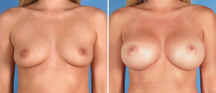 Before & After Breast Augmentation Case 24930 View #1 View in Alpharetta, GA