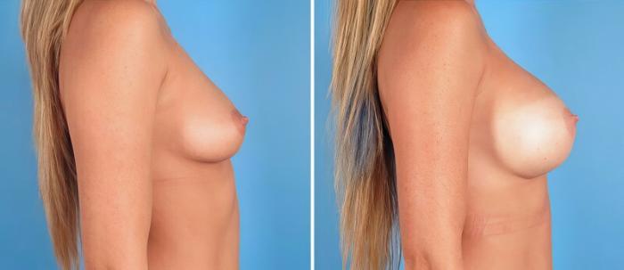 Before & After Breast Augmentation Case 24930 View #2 View in Alpharetta, GA