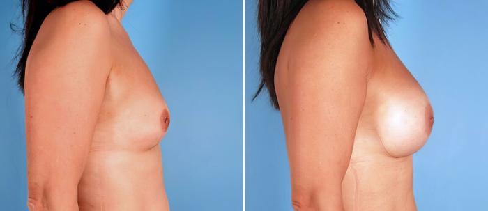 Before & After Breast Augmentation Case 24936 View #2 View in Alpharetta, GA