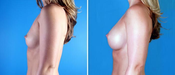 Before & After Breast Augmentation Case 25048 View #2 View in Alpharetta, GA