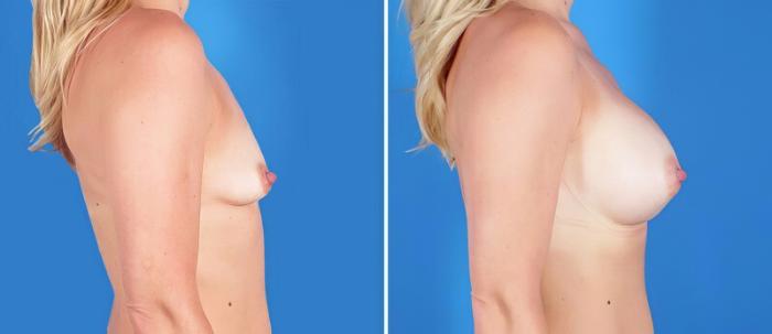 Before & After Breast Augmentation Case 25178 View #2 View in Alpharetta, GA