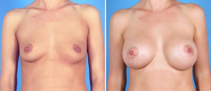 Before & After Breast Augmentation Case 25181 View #1 View in Alpharetta, GA