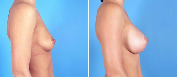 Before & After Breast Augmentation Case 25181 View #2 View in Alpharetta, GA