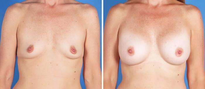 Before & After Breast Augmentation Case 25191 View #1 View in Alpharetta, GA