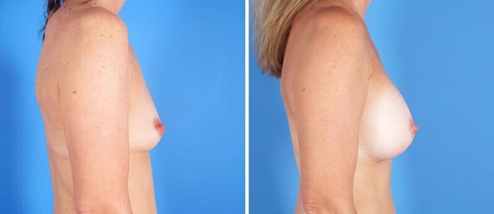 Before & After Breast Augmentation Case 25191 View #2 View in Alpharetta, GA