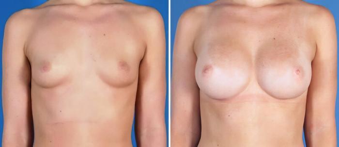 Before & After Breast Augmentation Case 25196 View #1 View in Alpharetta, GA