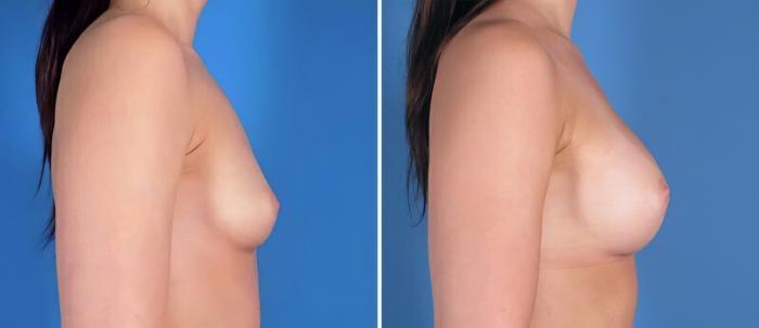 Before & After Breast Augmentation Case 25196 View #2 View in Alpharetta, GA