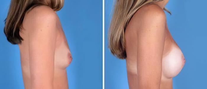 Before & After Breast Augmentation Case 25200 View #2 View in Alpharetta, GA