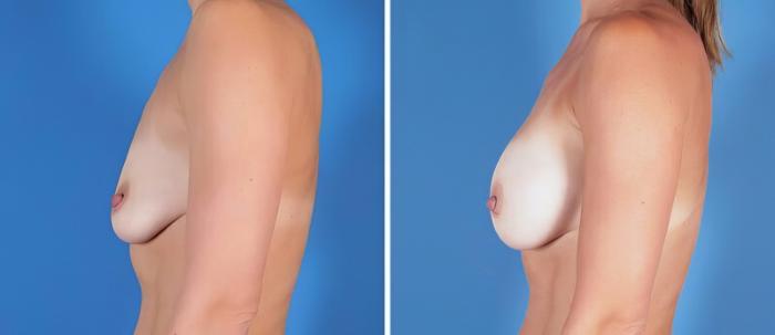Before & After Breast Augmentation Case 25203 View #2 View in Alpharetta, GA