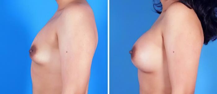 Before & After Breast Augmentation Case 25206 View #2 View in Alpharetta, GA