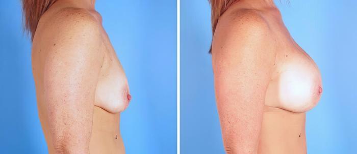 Before & After Breast Augmentation Case 25209 View #2 View in Alpharetta, GA