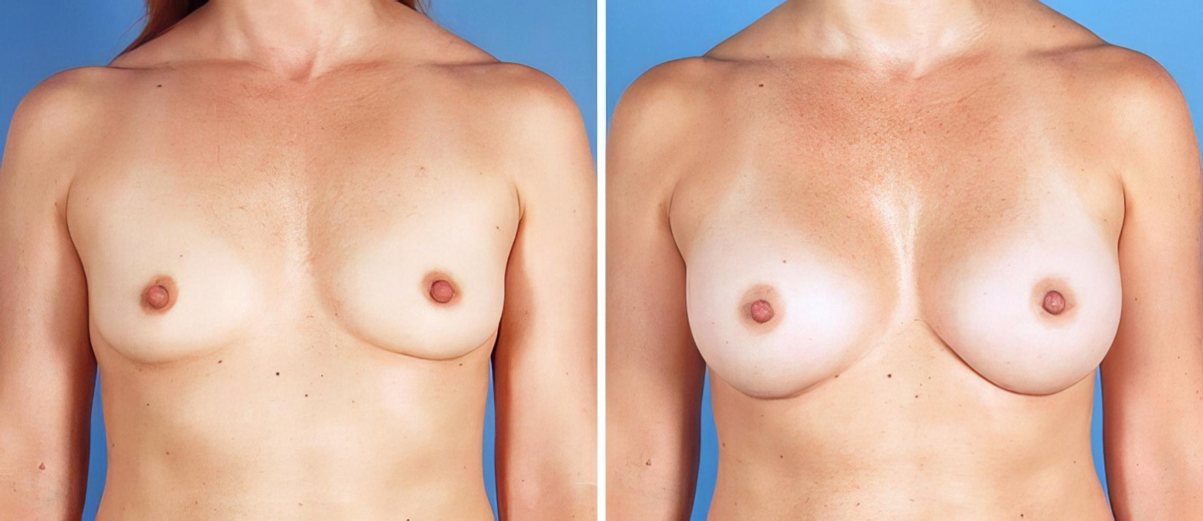Before & After Breast Augmentation Case 25212 View #1 View in Alpharetta, GA