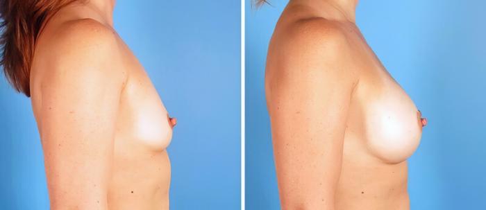 Before & After Breast Augmentation Case 25212 View #2 View in Alpharetta, GA
