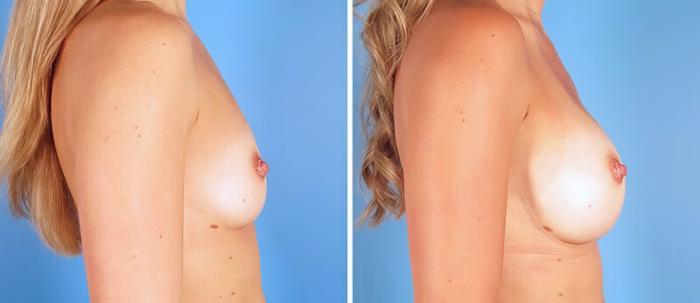 Before & After Breast Augmentation Case 25216 View #2 View in Alpharetta, GA