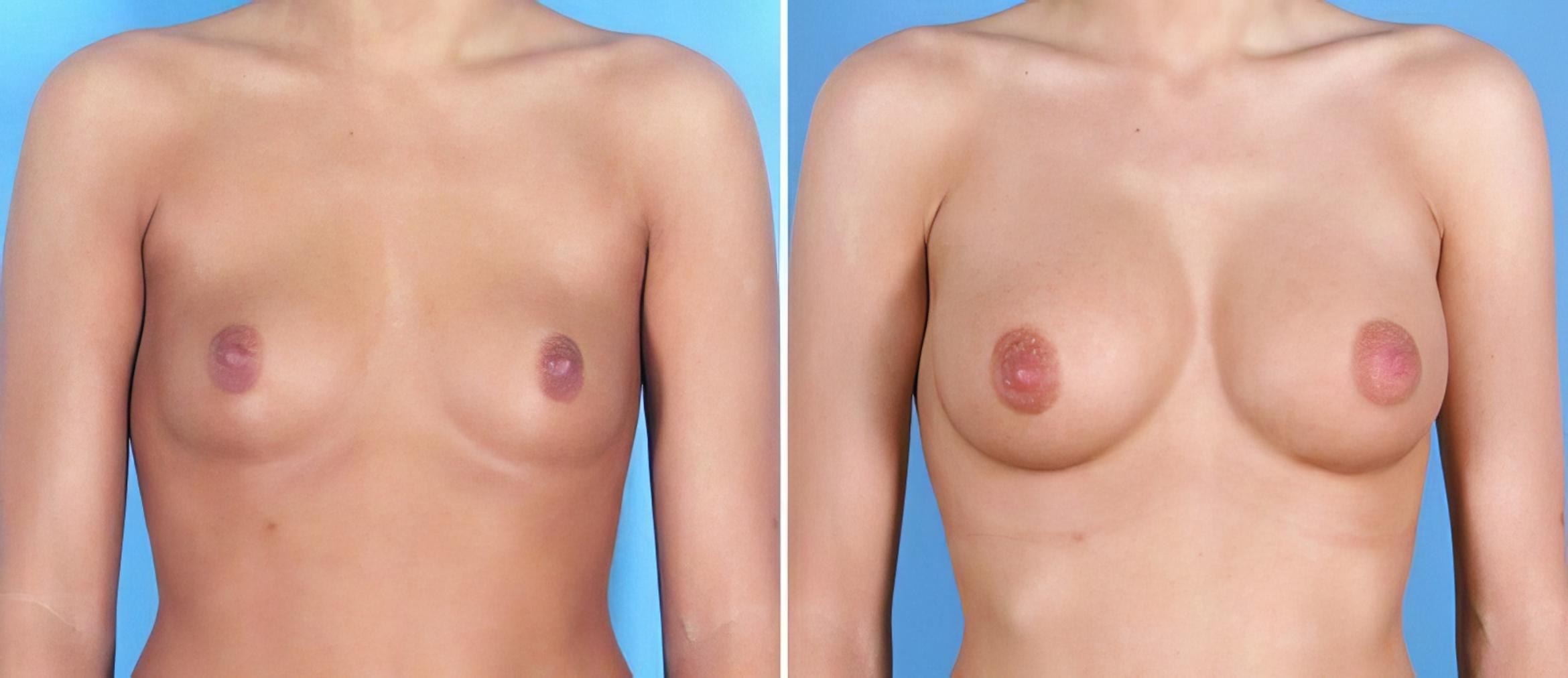 Before & After Breast Augmentation Case 25219 View #1 View in Alpharetta, GA