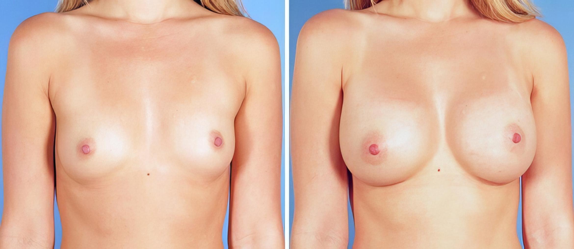 Before & After Breast Augmentation Case 25222 View #1 View in Alpharetta, GA
