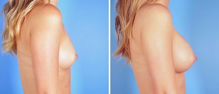 Before & After Breast Augmentation Case 25222 View #2 View in Alpharetta, GA