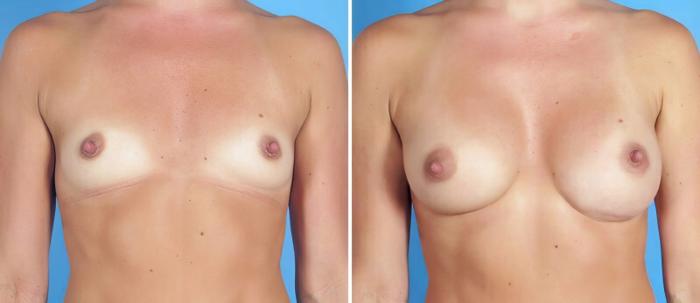 Before & After Breast Augmentation Case 25225 View #1 View in Alpharetta, GA