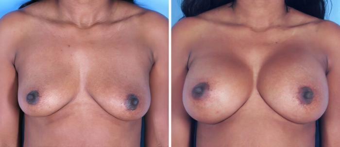 Before & After Breast Augmentation Case 25231 View #1 View in Alpharetta, GA