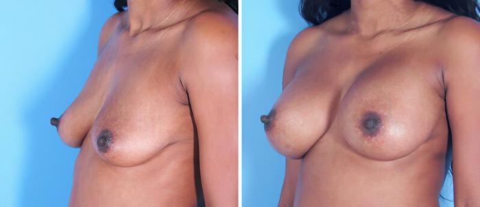 Before & After Breast Augmentation Case 25231 View #2 View in Alpharetta, GA