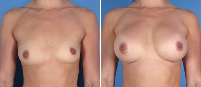 Before & After Breast Augmentation Case 25501 View #1 View in Alpharetta, GA