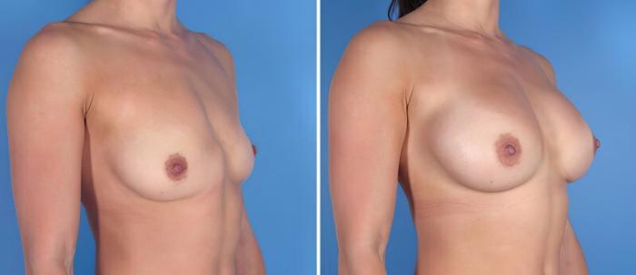 Before & After Breast Augmentation Case 25501 View #2 View in Alpharetta, GA