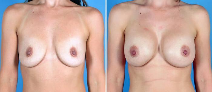 Before & After Breast Augmentation Case 25510 View #1 View in Alpharetta, GA