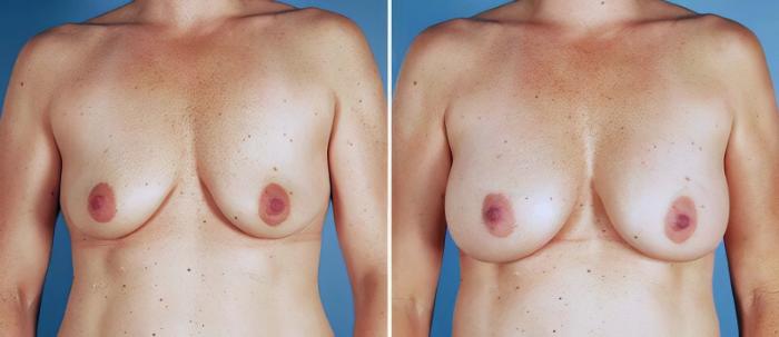 Before & After Breast Augmentation Case 25516 View #1 View in Alpharetta, GA