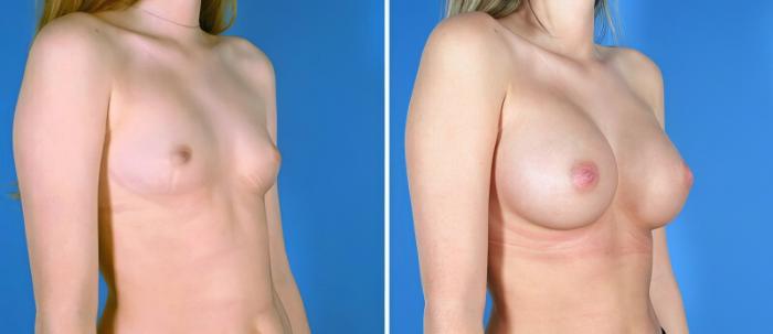 Before & After Breast Augmentation Case 25639 View #2 View in Alpharetta, GA