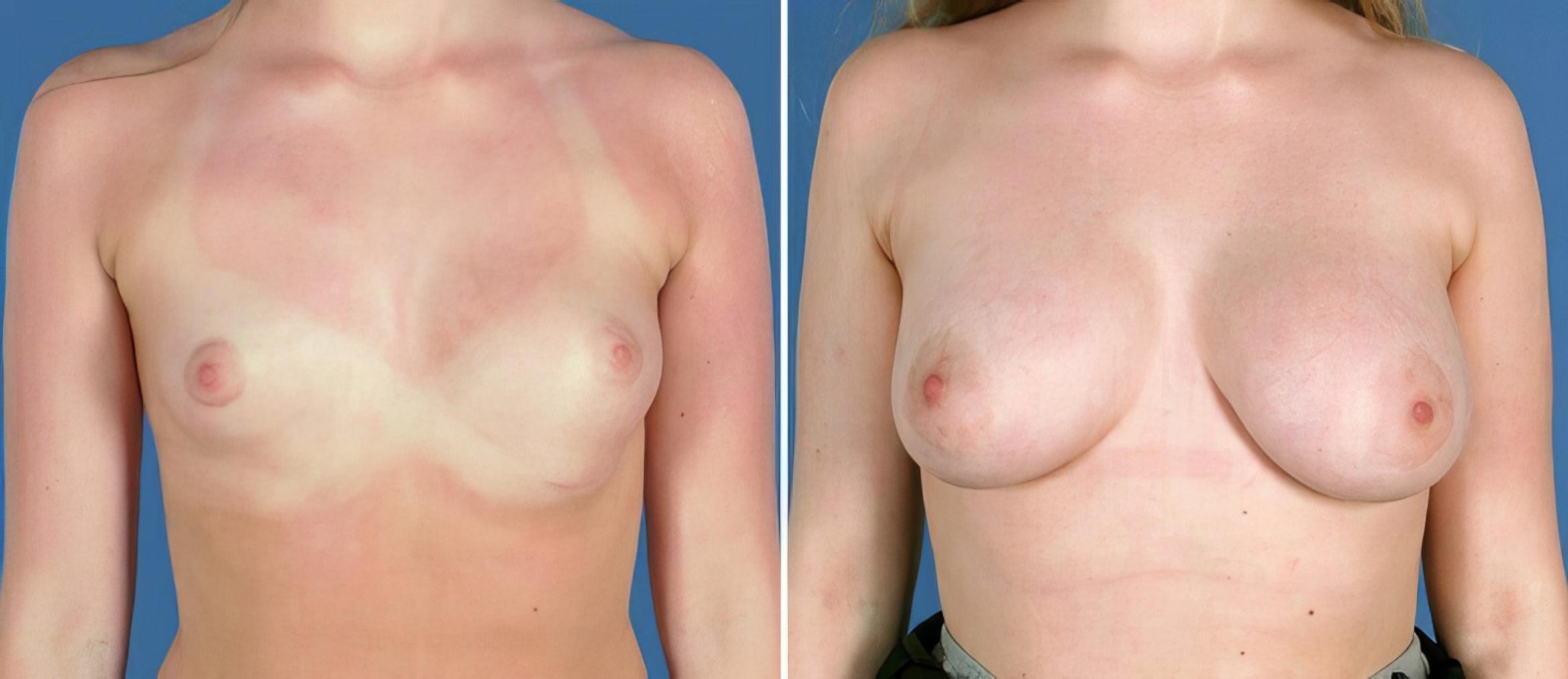 Before & After Breast Augmentation Case 25648 View #1 View in Alpharetta, GA