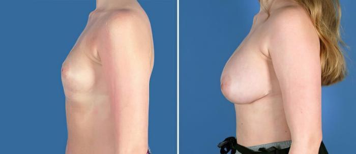 Before & After Breast Augmentation Case 25648 View #2 View in Alpharetta, GA