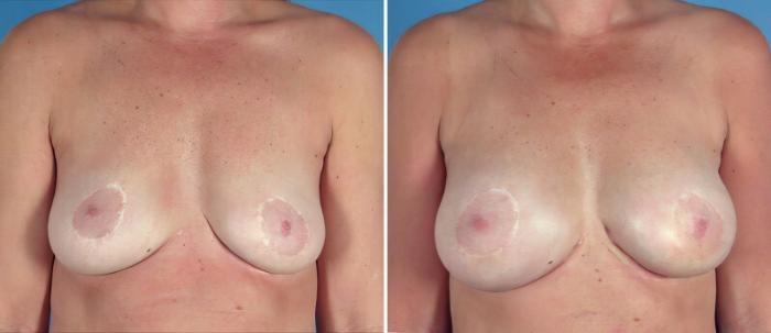 Before & After Breast Augmentation Case 25773 View #1 View in Alpharetta, GA