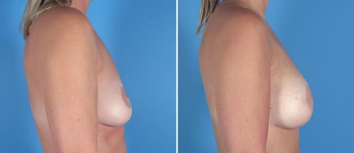 Before & After Breast Augmentation Case 25773 View #2 View in Alpharetta, GA