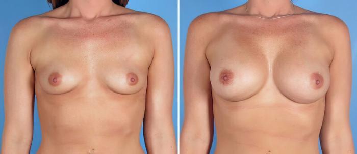 Before & After Breast Augmentation Case 25785 View #1 View in Alpharetta, GA