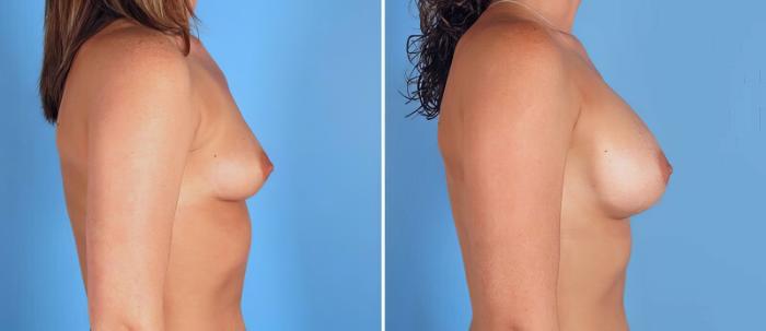 Before & After Breast Augmentation Case 25785 View #2 View in Alpharetta, GA