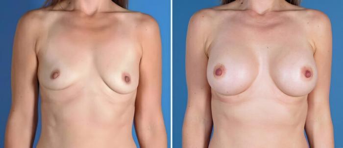 Before & After Breast Augmentation Case 25791 View #1 View in Alpharetta, GA