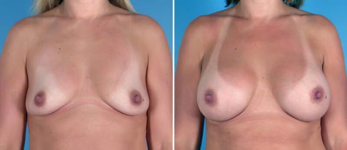Before & After Breast Augmentation Case 25810 View #1 View in Alpharetta, GA