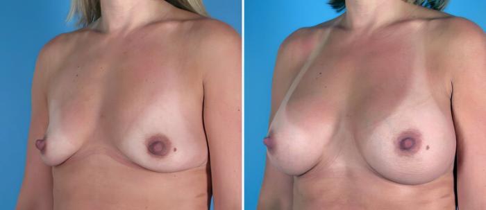Before & After Breast Augmentation Case 25810 View #2 View in Alpharetta, GA