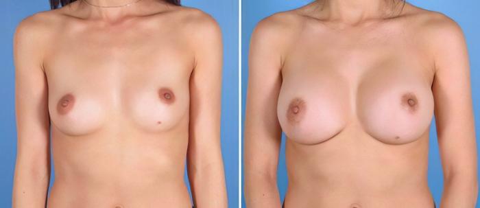 Before & After Breast Augmentation Case 25821 View #1 View in Alpharetta, GA