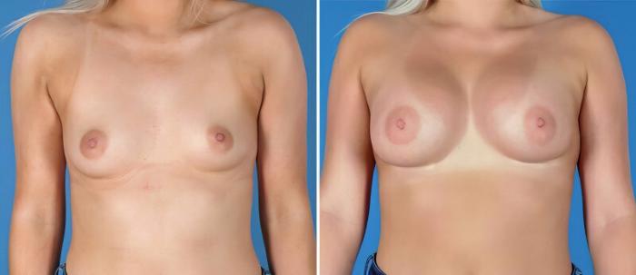 Before & After Breast Augmentation Case 25826 View #1 View in Alpharetta, GA