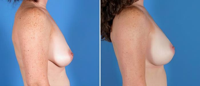 Before & After Breast Augmentation Case 25829 View #2 View in Alpharetta, GA