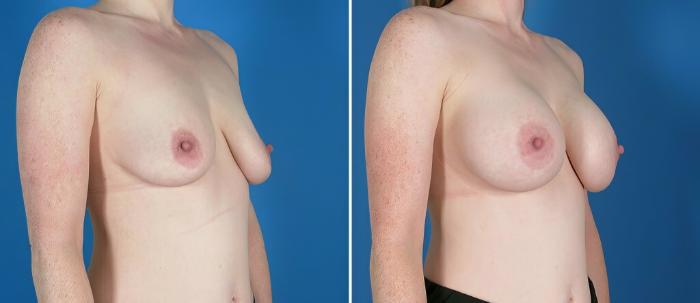 Before & After Breast Augmentation Case 26024 View #2 View in Alpharetta, GA