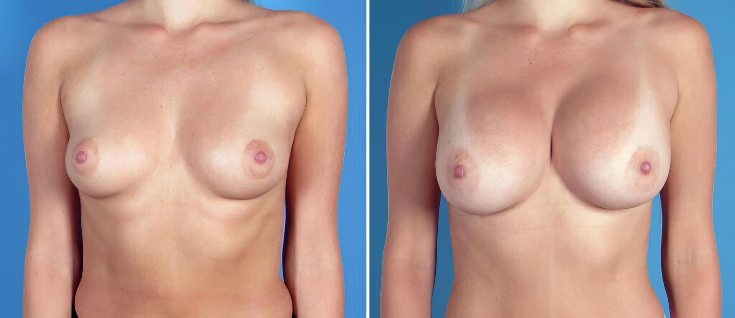 Before & After Breast Augmentation Case 26294 View #1 View in Alpharetta, GA