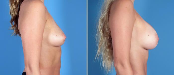 Before & After Breast Augmentation Case 26294 View #2 View in Alpharetta, GA